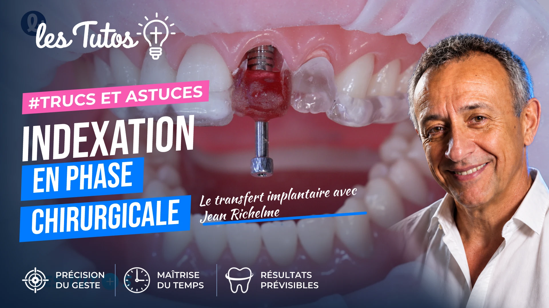 Indexation en phase chirurgicale