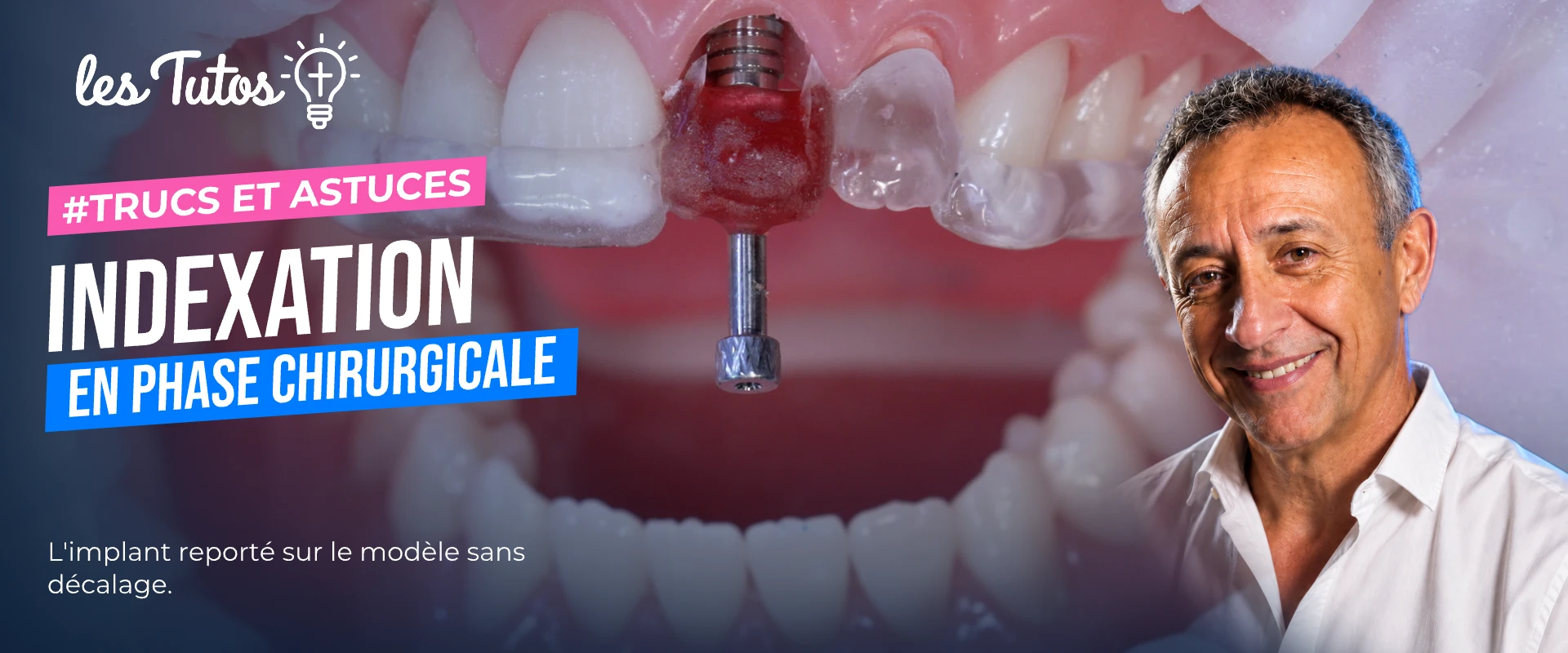 Indexation en phase chirurgicale