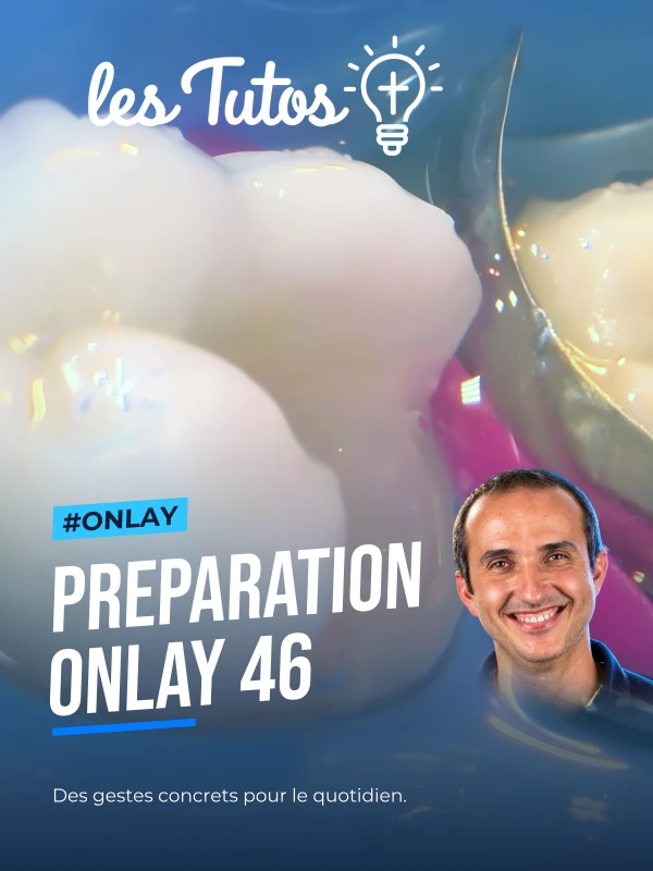 Preparation onlay 46 (Tuto, saison 2 épisode 18) : Tutoriel du Dr Gauthier Weisrock : les étapes d'une restauration postérieure collée (46) par…