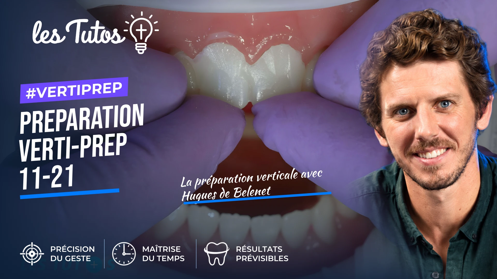 Preparation verti-prep 11-21 (Tuto, saison 2 épisode 19) : Démonstration muette du Dr Hugues de Belenet : une préparation Verti-Prep sur les…