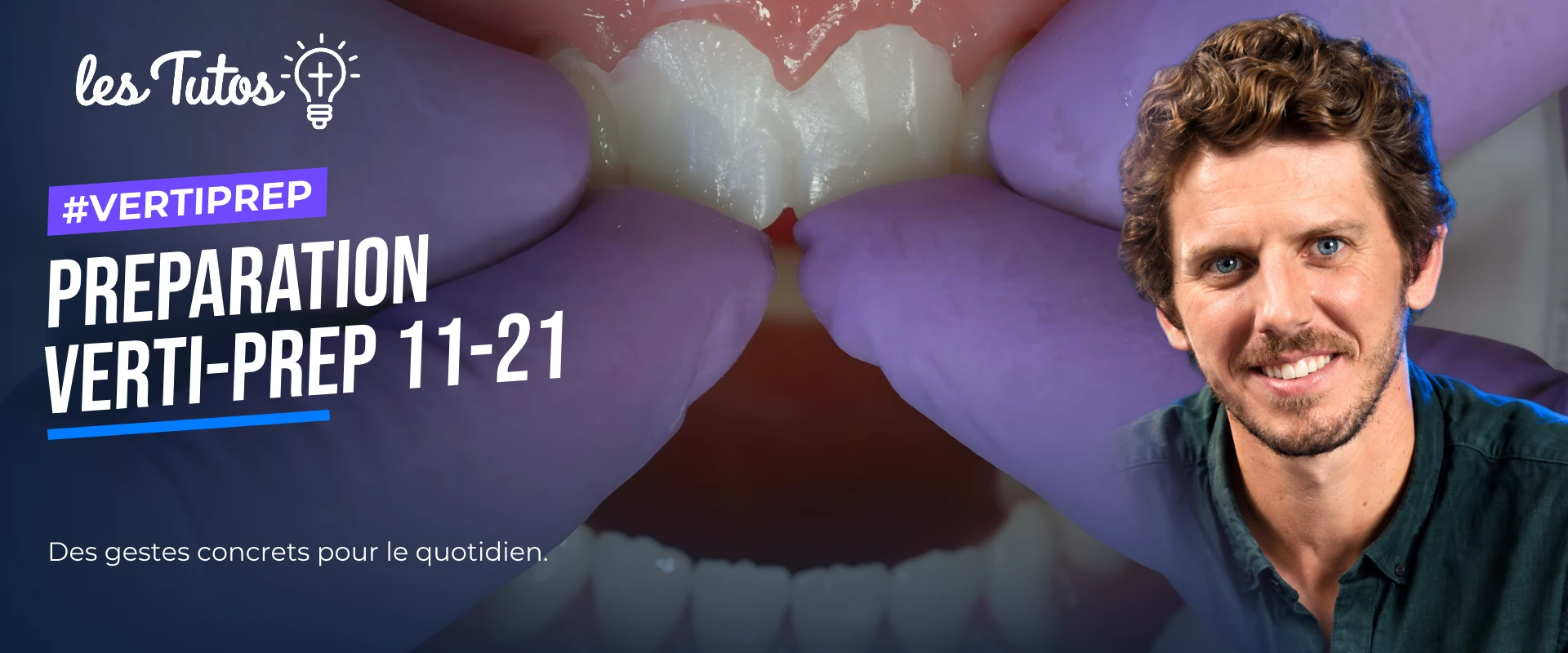 Preparation verti-prep 11-21 (Tuto, saison 2 épisode 19) : Démonstration muette du Dr Hugues de Belenet : une préparation Verti-Prep sur les…
