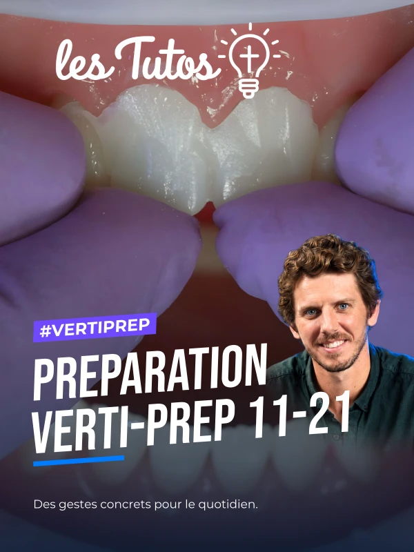 Preparation verti-prep 11-21 (Tuto, saison 2 épisode 19) : Démonstration muette du Dr Hugues de Belenet : une préparation Verti-Prep sur les…