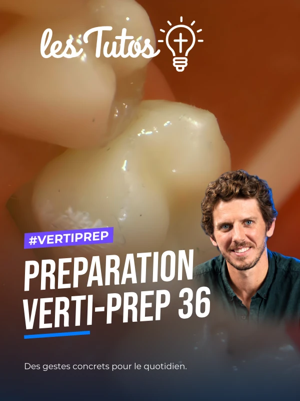 Preparation verti-prep 36 (Tuto, saison 2 épisode 21) : Démonstration muette : une préparation Verti-Prep sur la molaire 36, du build-up adhésif à…
