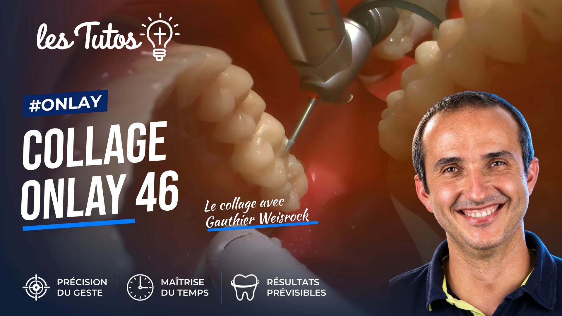 Collage onlay 46 (Tuto, saison 2 épisode 31) : Démonstration muette du Dr Gauthier Weisrock : le protocole de collage d'un onlay sur la 46, geste…