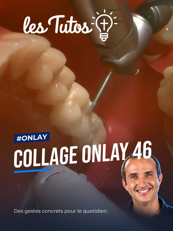 Collage onlay 46 (Tuto, saison 2 épisode 31) : Démonstration muette du Dr Gauthier Weisrock : le protocole de collage d'un onlay sur la 46, geste…